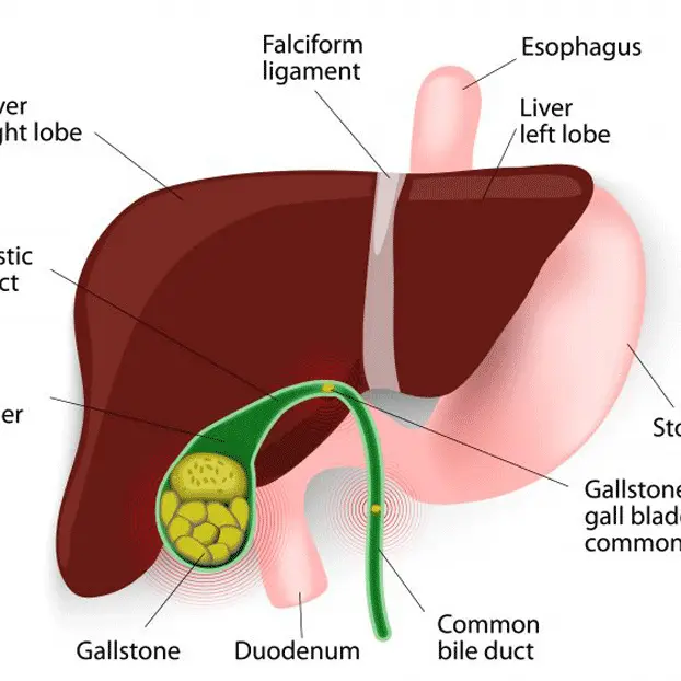 Gallbladder Stones