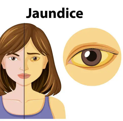 Jaundice
